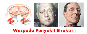 Illustration for article titled Obat Herbal Untuk Stroke Iskemik